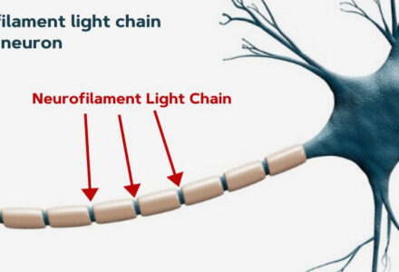 XÉT NGHIỆM NfL: “ĐÈN CẢNH BÁO” SỚM TỔN THƯƠNG THẦN KINH QUA MÁU